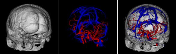 脳3D-CT Angiography画像