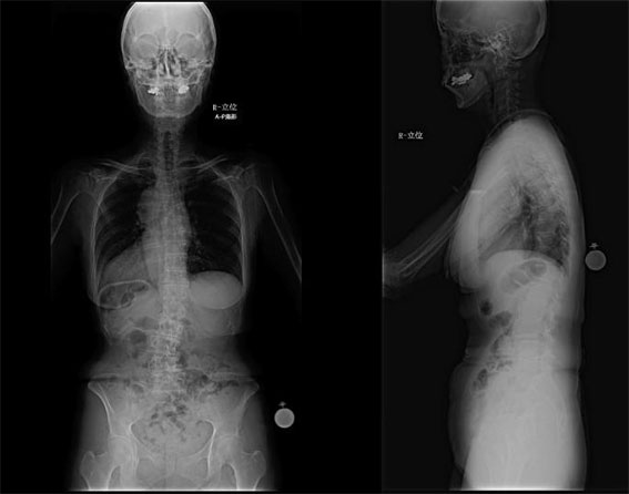 【図１】 術前の脊椎全長写真