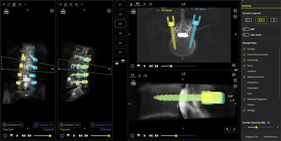 【図5】 MAZOR Xのプラニングソフト（UNiD ロッド適応後）