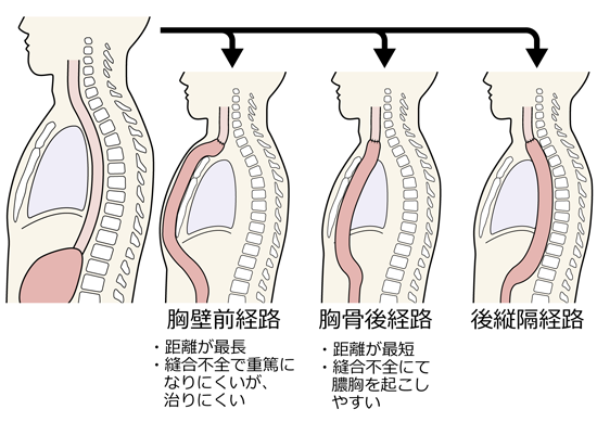 食道再建