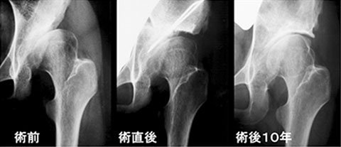 臼蓋不全に対する骨切り術