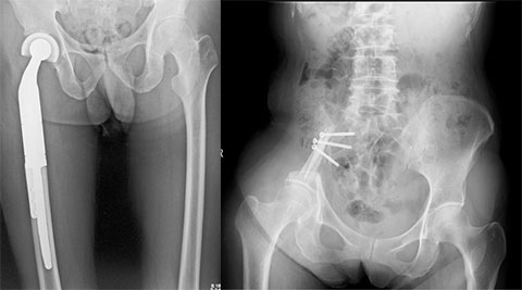 肺癌大腿骨近位骨腫瘍に対する広範切除、腫瘍用人工骨頭置換(左)<br>
骨盤悪性骨腫瘍に対する広範切除、再建術(右)